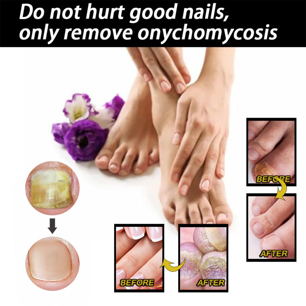 Nail Repair Solution Thickening Brightening Nails Removing Gray Nails Dead Skin Repair Nourishing Nail Care Solution