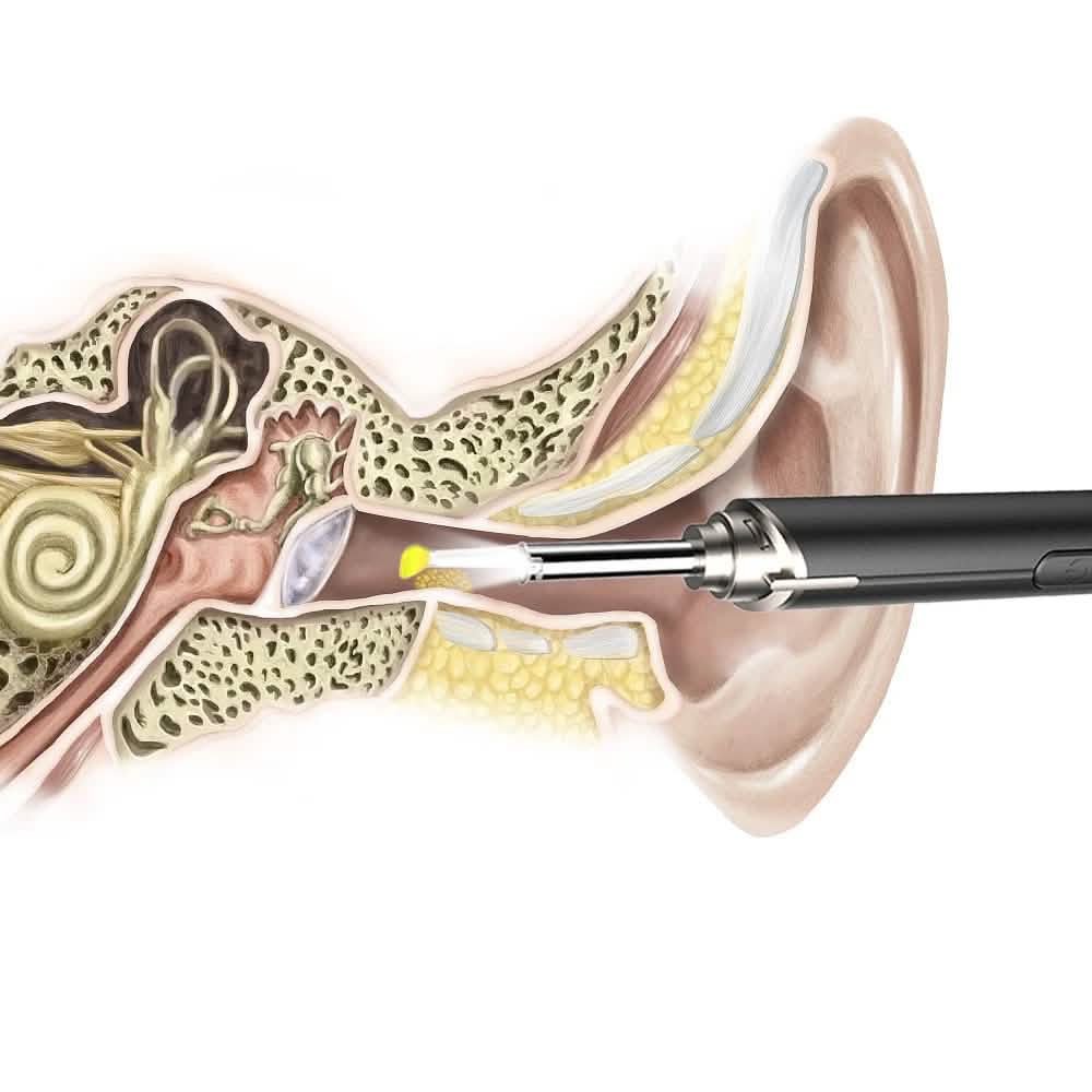 Intelligent Visual Ear Otoscope Inspection Tool – Erratic Behavior